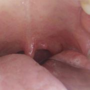 papilloma virus placche gola