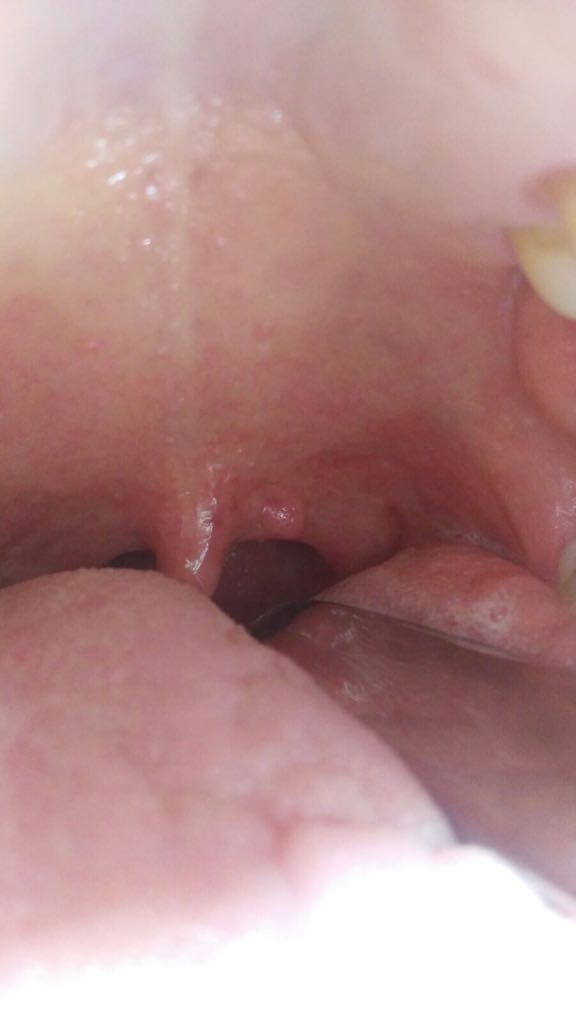 sintomi papilloma virus bocca