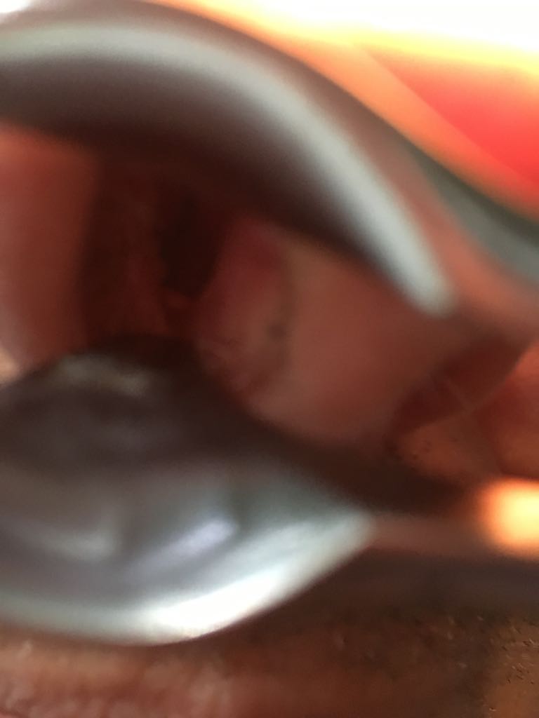 biopsia papilloma sulla lingua)
