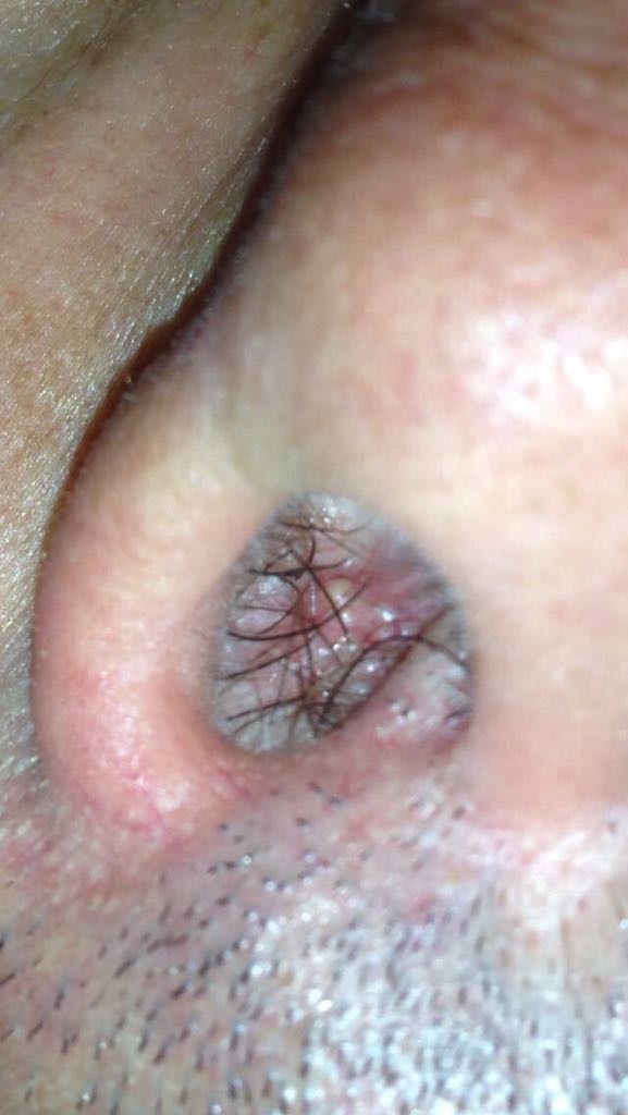 papilloma virus nel naso