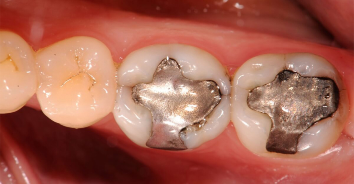 Amalgama dentaria mercurio